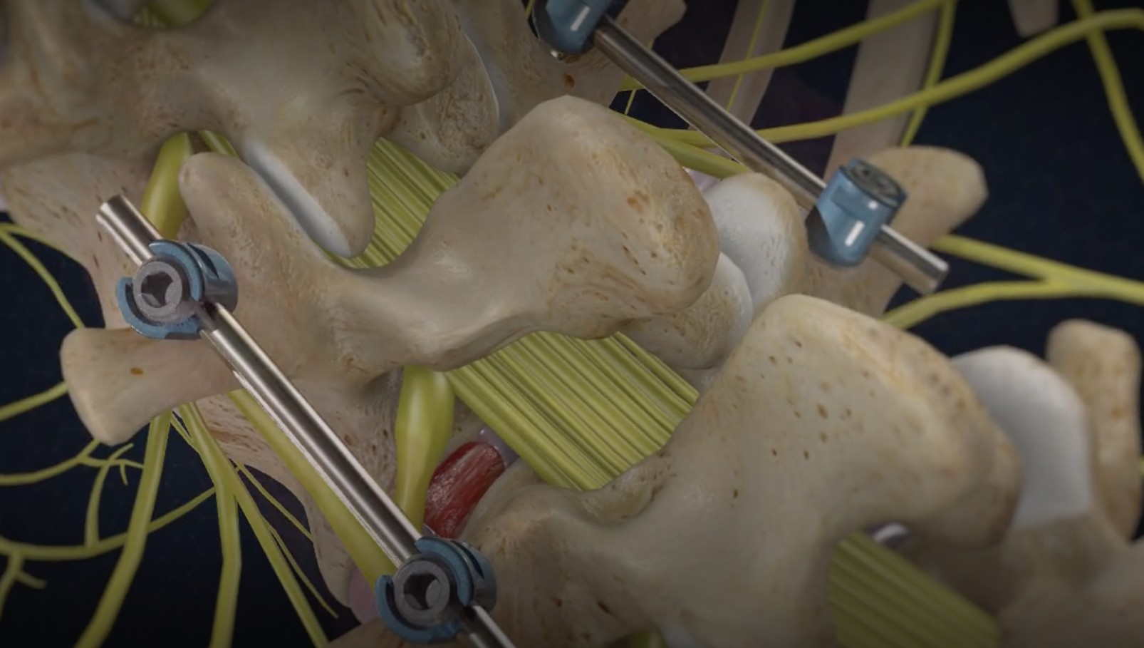 transforaminal-lumbar-interbody-fusion-tlif-surgery-in-dallas-tx